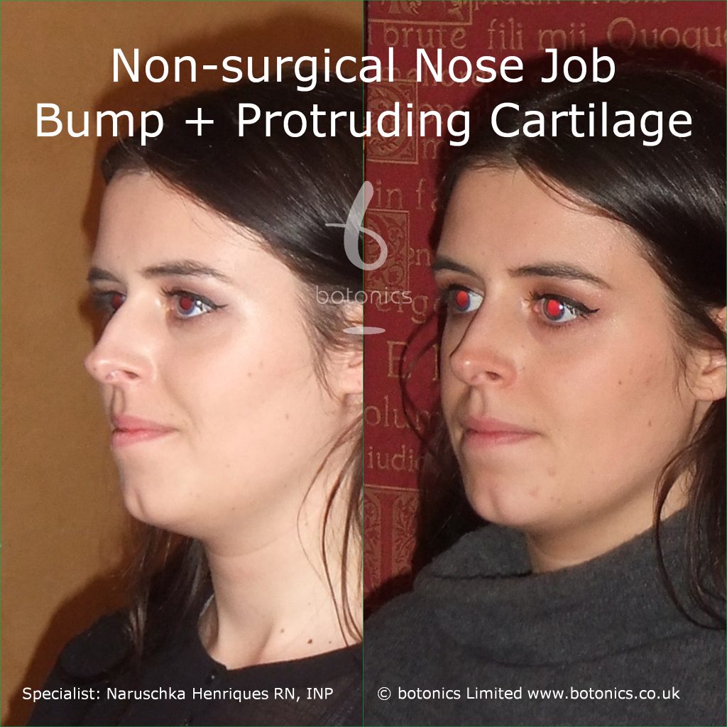 non_surgical_rhinoplasty_bump_protruding_cartilage_pointy_nose_tip