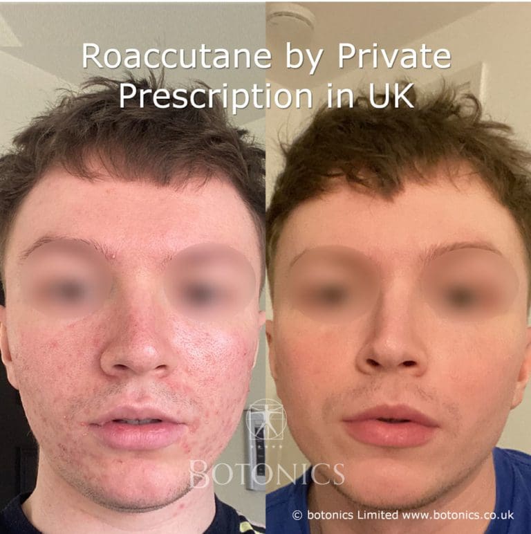 Before And After Roaccutane Treatment For Acne Botonics