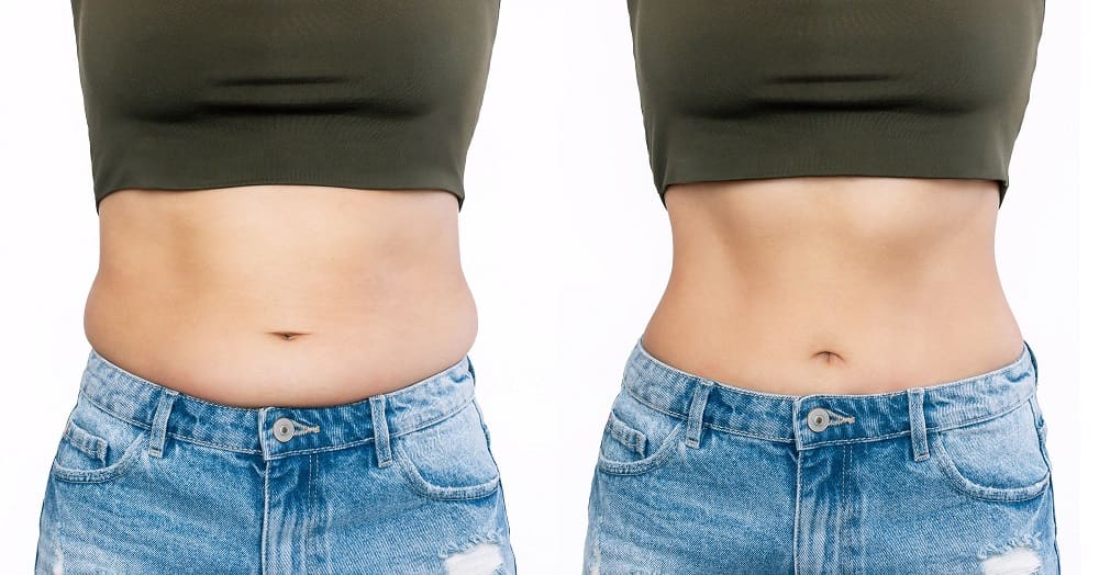 Vaser Liposuction Recovery: Tips To Recover Quickly