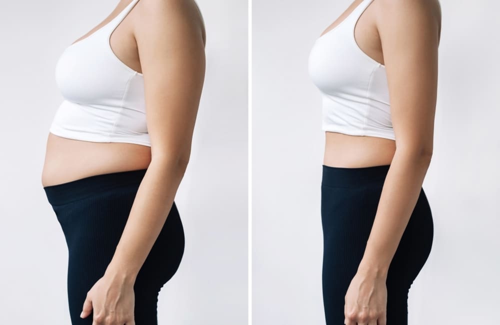 How Long Does Vaser Liposuction Take?