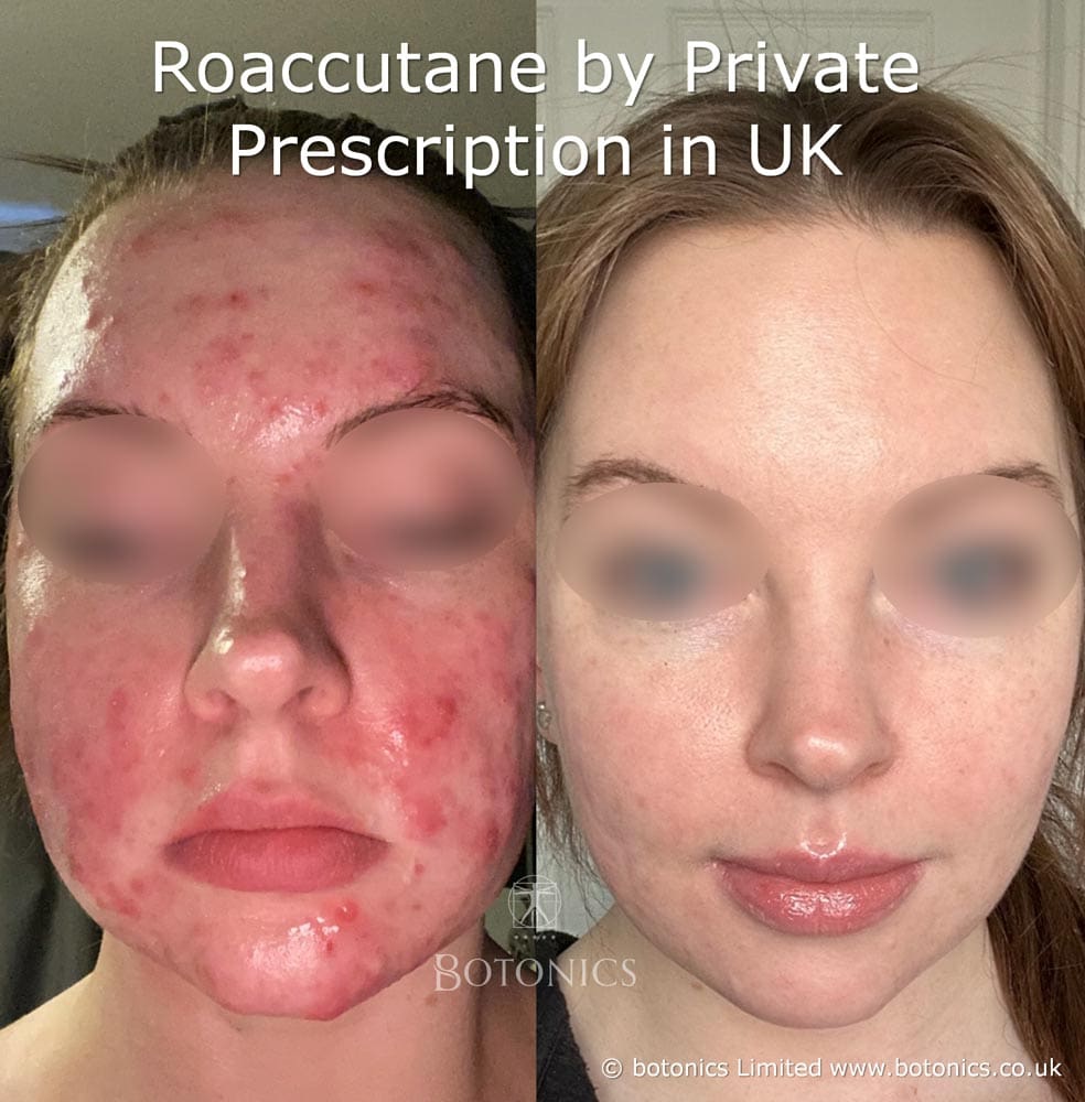 Young woman before and 6 months after Roaccutane treatment. This patient went from red, cystic acne to beautifully clear skin