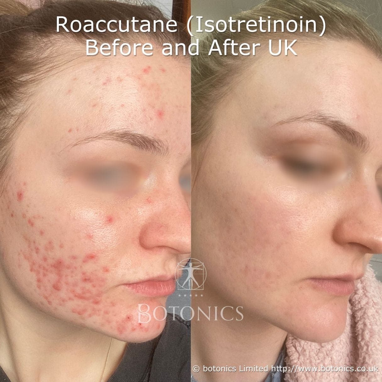 Before and after results of Roaccutane (Isotretinoin) treatment for acne after 8 months.