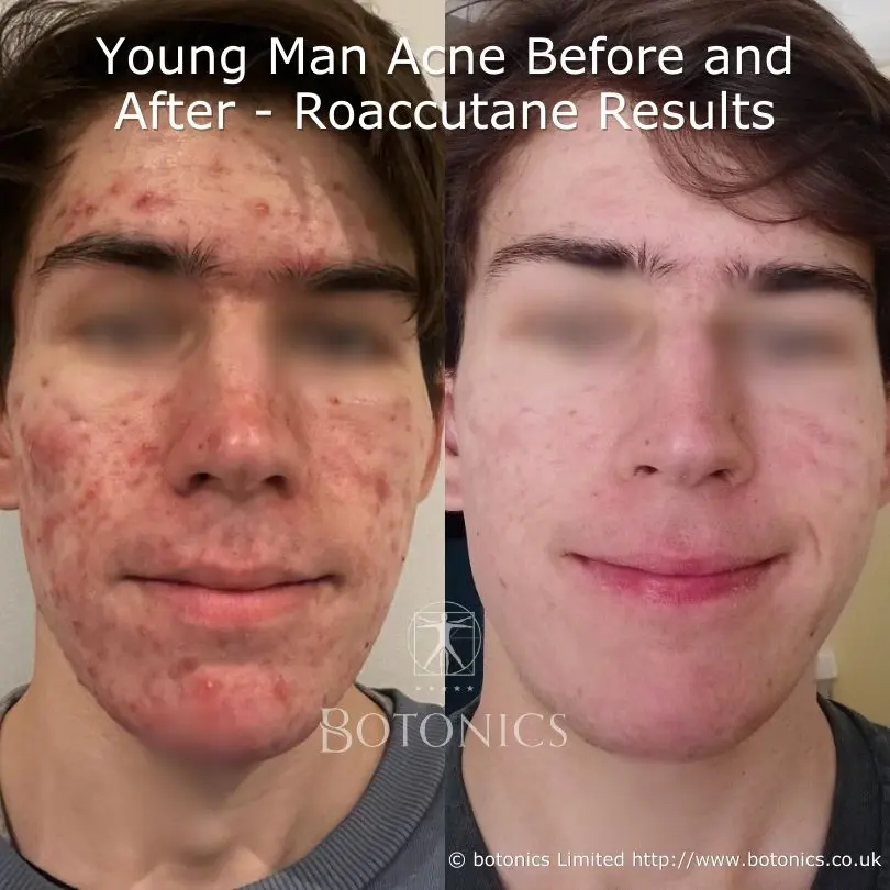 21-year-old man's 6-month isotretinoin (Roaccutane) acne treatment before and after results, showcasing clearer skin.