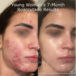 23-year-old woman's 7-month isotretinoin (Roaccutane) acne treatment before and after results, showing clearer skin.