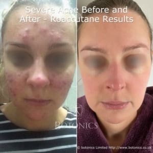 27-year-old woman's 6-month isotretinoin (Roaccutane) treatment results for severe acne before and after transformation.