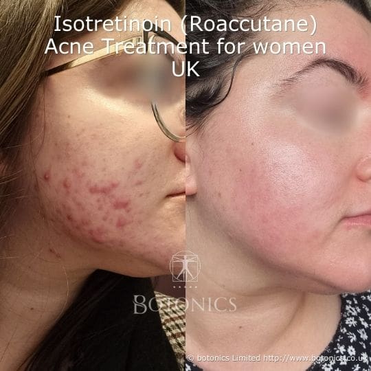 Before and after 6-month transformation of severe cystic acne treated with Roaccutane for a 31-year-old patient