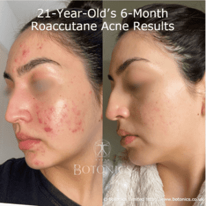 21-year-old woman's 7-month isotretinoin (Roaccutane) acne treatment before and after results, showing clearer skin.