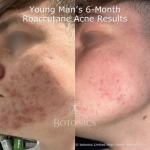 Young man’s 6-month isotretinoin (Roaccutane) acne treatment before and after results, showing clear skin improvement.